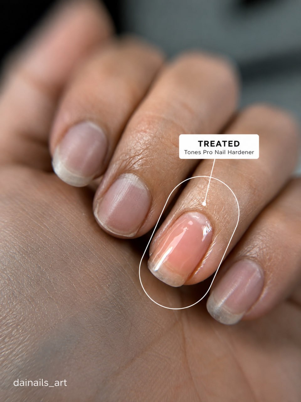 Real demonstration showing only the highlighted nail treated with Tones Pro Nail Hardener